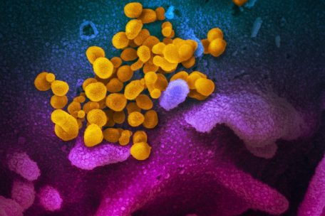 Unter dem Elektronenmikroskop ist zu erkennen, wie die Coronaviren (gelb markiert) aus der infizierten Zelle austreten